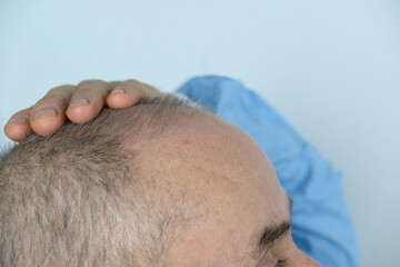 close-up old bald charismatic mature man showing his hair fall from head, patient with alopecia in hair growth clinic, topic of hair loss in men, selective focus. Anti-aging treatments for balding men