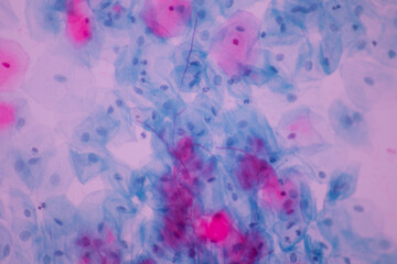 View in microscopic of Candidiasis, fungus infection (Yeast and Pseudohyphae form) in pap smear slide cytology and diagnostic by pathologist.Gynecology report and diagnosis.Medical concept.400X
