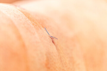 Close-up of a suture after an athroscopy surgery