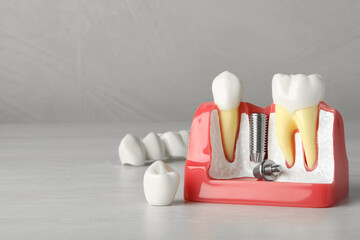 Educational model of gum with post for dental implant between teeth and crowns on white wooden table