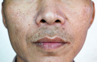 Rough skin in face of Asian, Myanmar or Korean man.