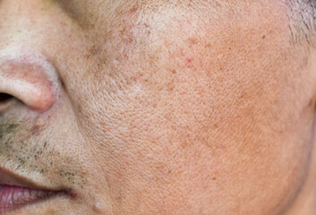 Fototapeta premium Wide pores at rough skin in face of Asian, Myanmar or Korean man.