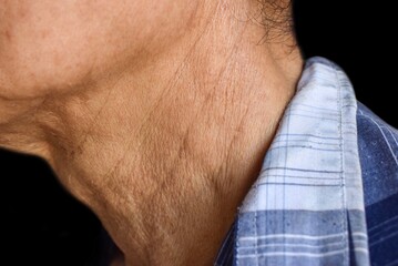Aging skin folds, creases or wrinkles at neck of Asian old man.
