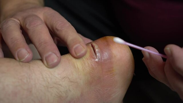 Wound treatment from suppuration with a cotton