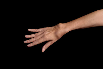 Deformed wrist with Rheumatoid arthritis