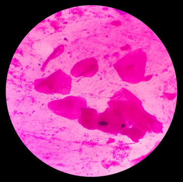 Gram stain of throat swab: Microscopic view show plenty epithelial cells and few gram positive diplococci and few gram negative rods bacteria.