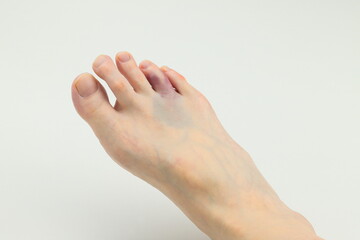 右足薬指の強打による打撲傷