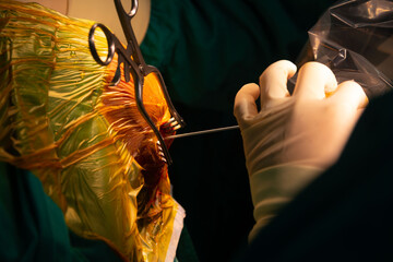 Neurosurgeon performing stereotactic brain biopsy in operating room.