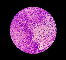 Photomicrograph of an sinonasal inverted papilloma (SNIP), a benign tumor that may occur in the nasal cavity or paranasal sinuses, 40X