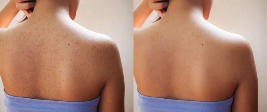 Image before and after treatment spot scar acne pimples on skin back of teenage women. 