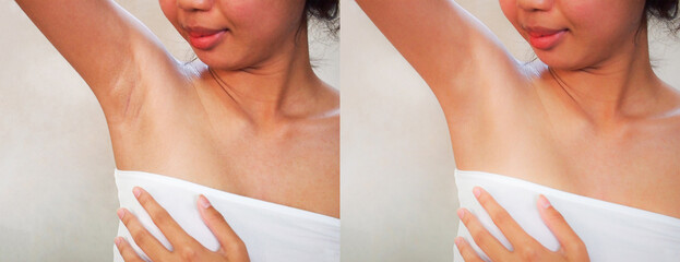 Image before and after skincare cosmetology armpits epilation treatment concept.Problem underarm...
