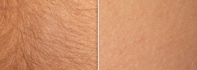 Macro of a woman's skin before and after an epilation treatment