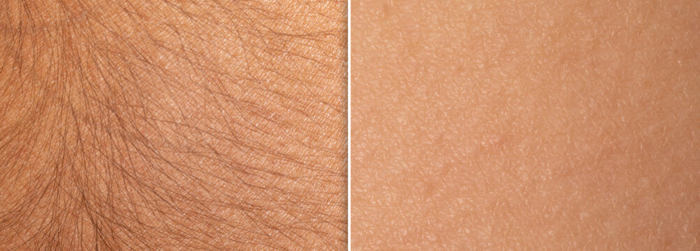 Macro of a woman's skin before and after an epilation treatment