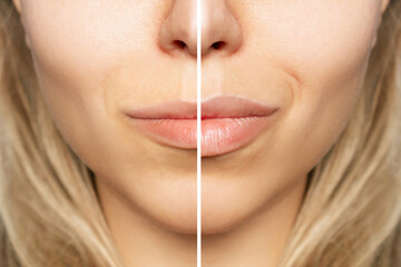 Cropped shot of young caucasian blonde woman's face with lips before and after lip enhancement....