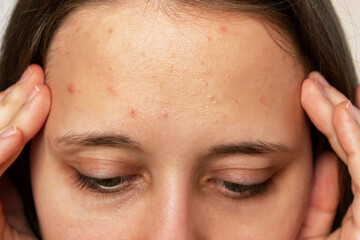 Cropped shot of a young woman's face with the problem of acne. Pimples on the forehead. Allergies, ...