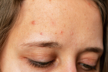Close up of pimples on the forehead. Cropped shot of a young woman's face with the problem of acne....