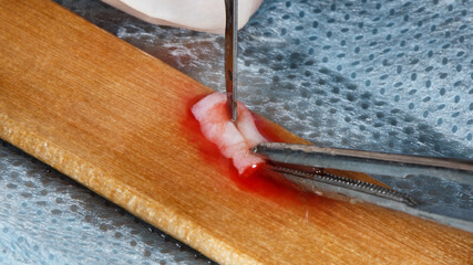Surgeon cuts the flap soft tissue for transplanting to the gums