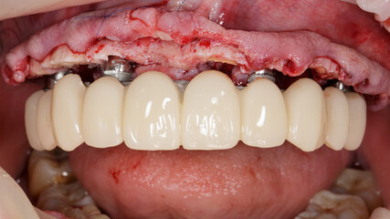 The prosthesis of temporary wearing from the polymer in the mouth with the reduction of the robe