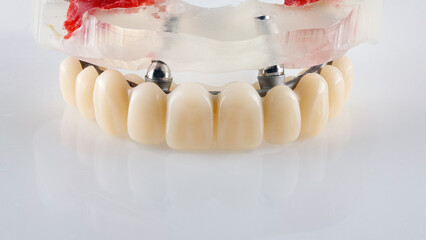 Prosthesis of temporary wearing for total implantation on the model