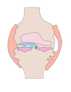 Knee in Rheumatoid Arthritis with Pannus formation 
