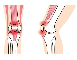 ジャンパー膝　膝関節　説明図　スポーツ障害
