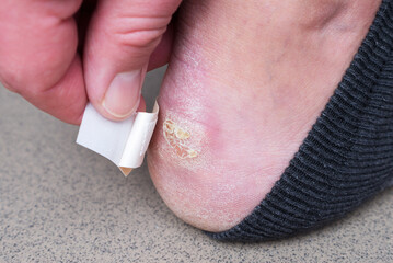 Large dry callus on the heel. Consequences of wearing uncomfortable, tight shoes.