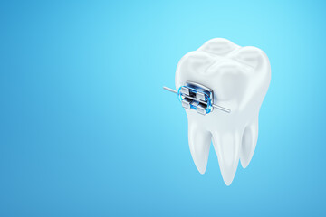 White teeth with metal braces on a blue background. Dental braces, orthodontic treatment, dentistry, teeth whitening, protection, oral care, hygiene, healthcare. 3D illustration, 3D render. - obrazy, fototapety, plakaty