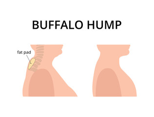 Patient with buffalo hump with fat deposits around the vertebrae. Dowager's hump, kyphosis, spine. For topics like post-menopause, osteoperosis, scoliosis 