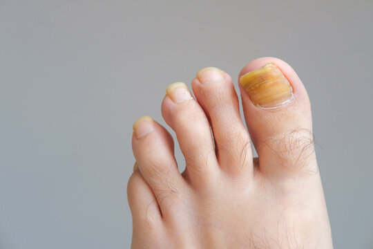 Twisted and deformed big toemail of a man