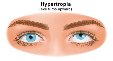 Squint eye (Strabismus). Hypertropia, eye turns upward. Deflection of visual axes. Vector illustration.