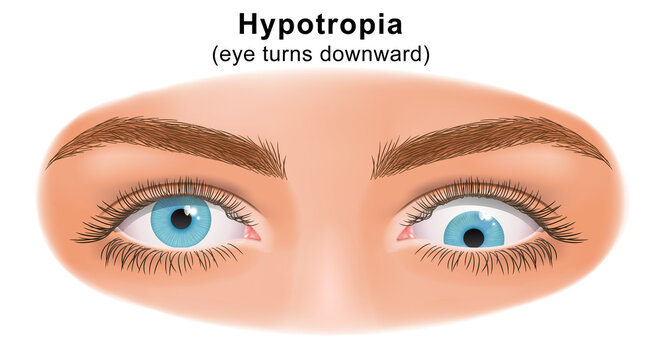 Squint eye (Strabismus). Hypotropia, eye turns upward. Deflection of visual axes. Vector illustration.