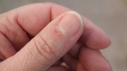 Close up of torn, ripped and picked on cuticle skin on a woman's thumb                               