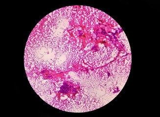 Photomicrograph of Mucoepidermoid carcinoma of parotid gland