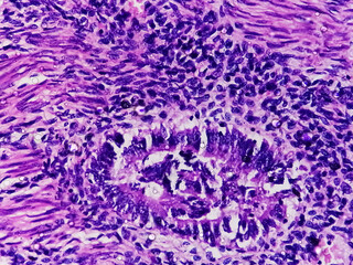 Microscopic view of Mucoepidermoid carcinoma. 100x