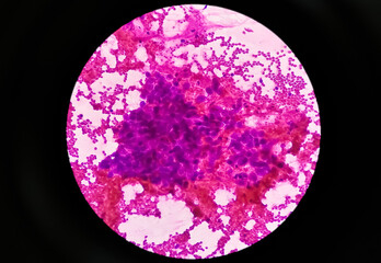 Photomicrograph of Mucoepidermoid carcinoma of parotid gland