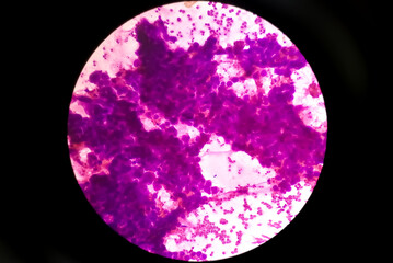 Photomicrograph of Mucoepidermoid carcinoma of parotid gland