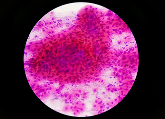Pap's smear pap stain Microscopic 40x Zoom show High-grade squamous intraepithelial lesion is a...