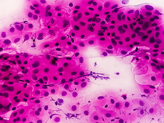 Pap's smear pap stain Microscopic 100x Zoom show High-grade squamous intraepithelial lesion is a...