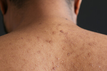 close up of young man suffering skin problem .