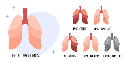 Healthy lungs, respiratory system. Diseases: pneumonia, lung abscess, pleuritis, tuberculosis, cancer. Pulmonology. Vector flat cartoon illustration. Perfect for medical flyer, brochure - 482405281