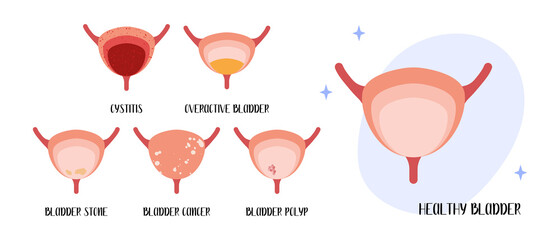 Healthy bladder. Diseases: cystitis, overactive bladder, stones, cancer, polyp. Urology. Vector flat cartoon illustration. Perfect for medical flyer, brochure