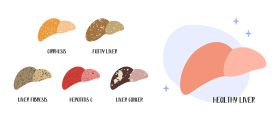 Healthy liver. Diseases: cirrhosis, fatty, fibrosis, hepatitis c, cancer. Hepatology. Vector flat cartoon illustration. Perfect for medical flyer, brochure - 482405284