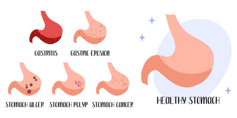 Healthy stomach. Diseases: gastritis, gastric erosion, ulcer, cancer, polyp. Gastroenterology. Vector flat cartoon illustration. Perfect for medical flyer, brochure