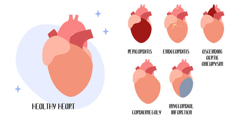 Healthy heart. Cardiovascular diseases: pericarditis, endocarditis, myocardial infarction, cardiomegaly, aneurysm. Cardiology. Vector flat cartoon illustration. Perfect for medical flyer, brochure - 482405287