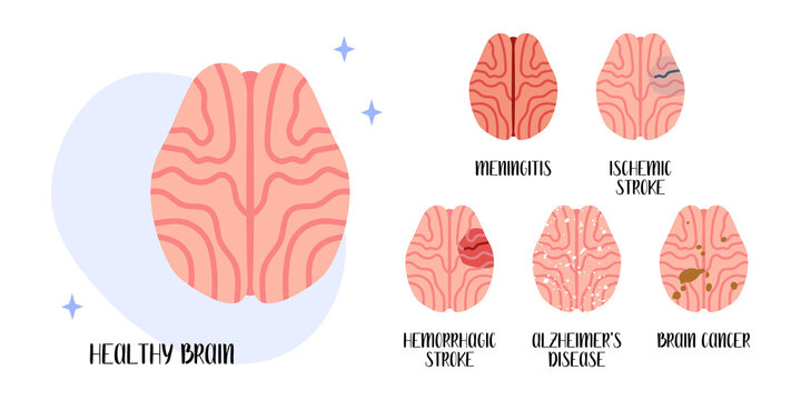 Healthy brain. Diseases: meningitis, ischemic and hemorrhagic stroke, alzheimer's disease, cancer. Neurobiology. Vector flat cartoon illustration. Perfect for medical flyer, brochure