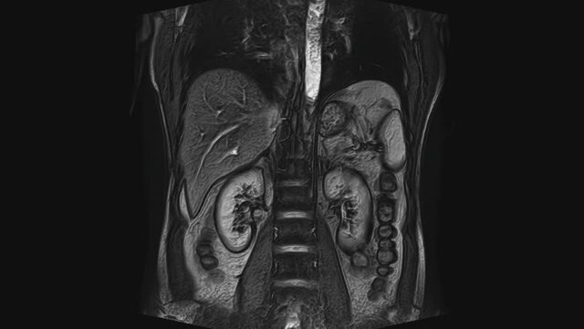Voluminous CT scan of the abdomen. Computed tomography of the gastrointestinal tract, liver and kidneys