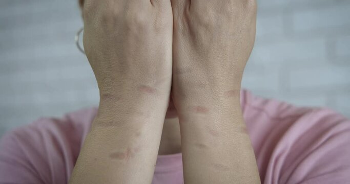 Bruises from torture. The woman hides her face with bruised hands. Domestic Violence.