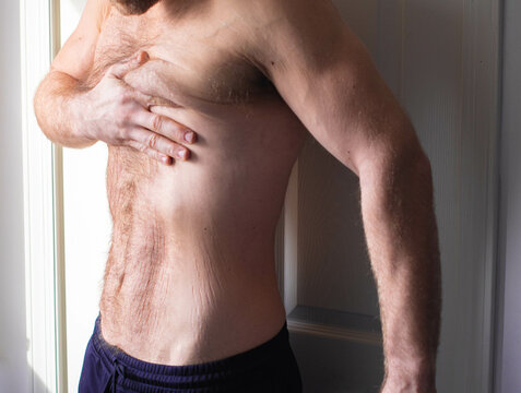 Fit white man after weight loss pulling on his loose skin, stretch marks on the belly.