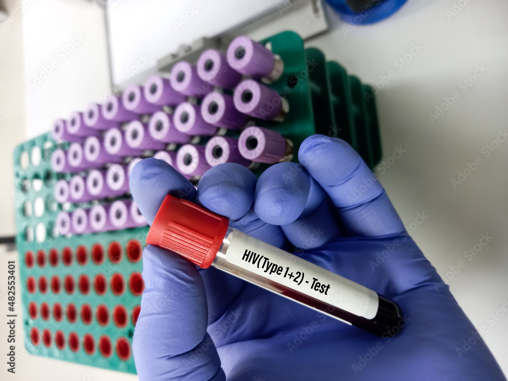 Poster Scientist hold test tube with blood sample for HIV type 1 and HIV type 2 antibody testing, hiv screening test