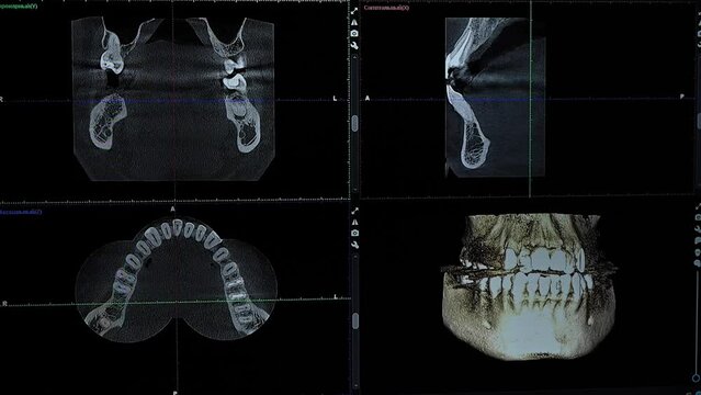 3d model of an x-ray image of a human jaw. Computer program for dental imaging